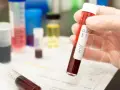 Leczenie HIV w Polsce: Bezpłatne ARV dla każdego? Sprawdź zasady!