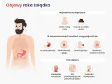 Objawy raka żołądka: utrata masy ciała, czarne stolce, uczucie pełności, niestrawność, zgaga, utrata apetytu, nudności, wymioty, osłabienie, ból pleców, trudności w połykaniu.