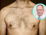 Mężczyzna z licznymi znamionami na klatce piersiowej i ramieniu. Lekarz w okularach w okręgu. Temat: rak sutka u mężczyzn.