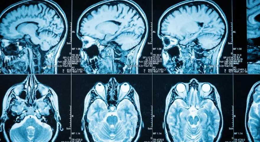 Przekroje mózgu na rezonansie magnetycznym. Widoczne struktury mózgu, które mogą pomóc w diagnostyce guzów mózgu objawy.