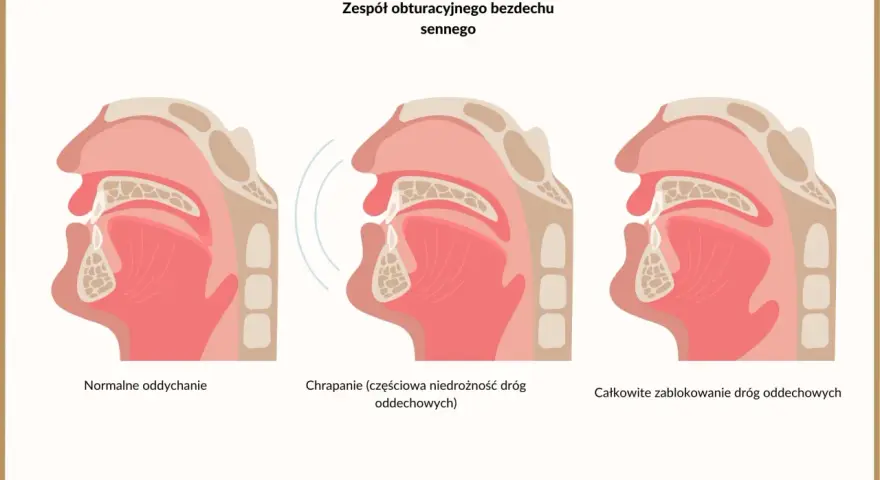 Ilustracja pokazuje, jak zwężenie dróg oddechowych prowadzi do bezdechu sennego. Objawy obejmują normalne oddychanie, chrapanie i całkowite zablokowanie dróg oddechowych.