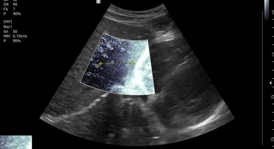 Obraz USG pokazuje guz na wątrobie o wymiarach 3,76 cm. Widoczna jest zmiana o nieregularnych granicach.