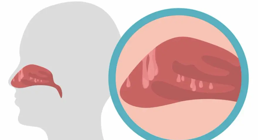Ilustracja przedstawia przekrój głowy z widocznymi polipami w nosie. Powiększony fragment ukazuje te łagodne narośla.
