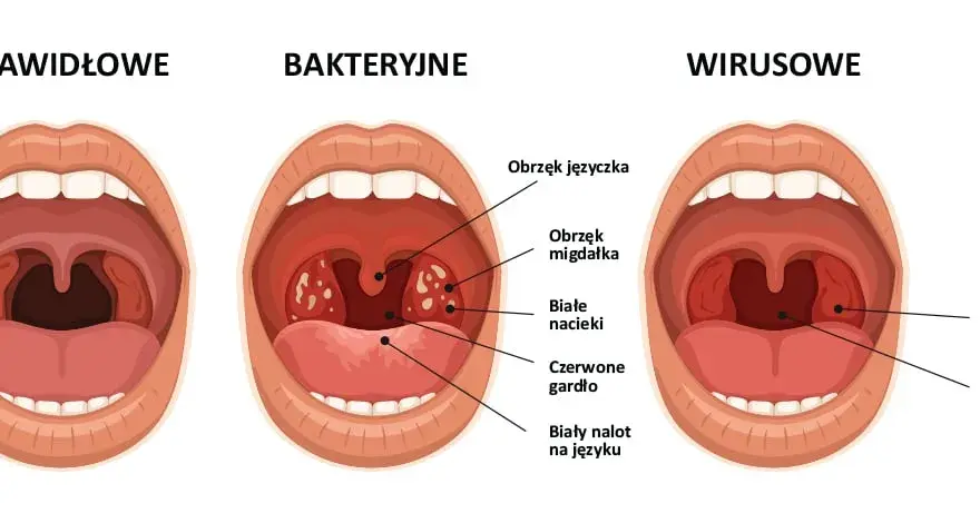 Ból gardła: Wirusy, bakterie, alergie? Poznaj prawdziwe powody!