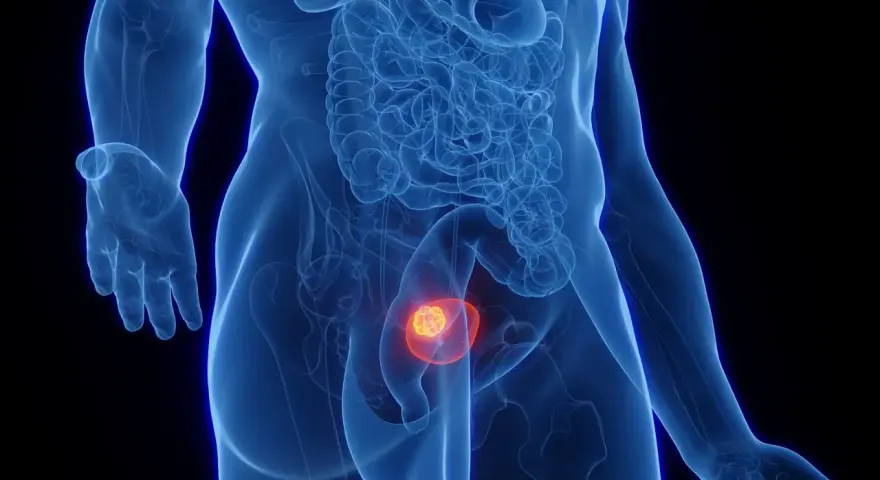 Anatomical illustration showing a tumor within the bladder, highlighting potential rak pęcherza objawy.
