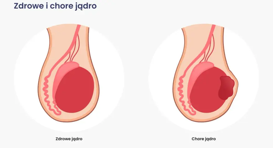 Ilustracja porównuje zdrowe jądro z chorym, na którym widoczny jest guz. Wczesne wykrycie raka jądra jest kluczowe.