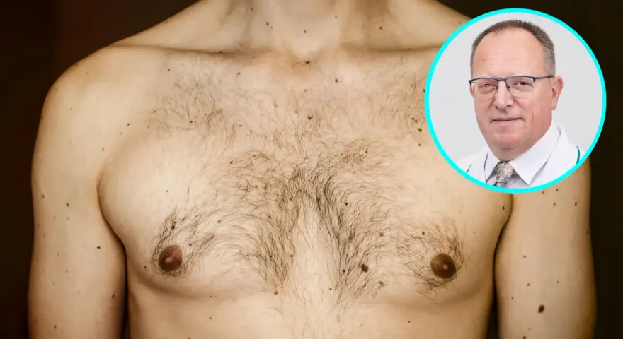 Mężczyzna z licznymi znamionami na klatce piersiowej i ramieniu. Lekarz w okularach w okręgu. Temat: rak sutka u mężczyzn.