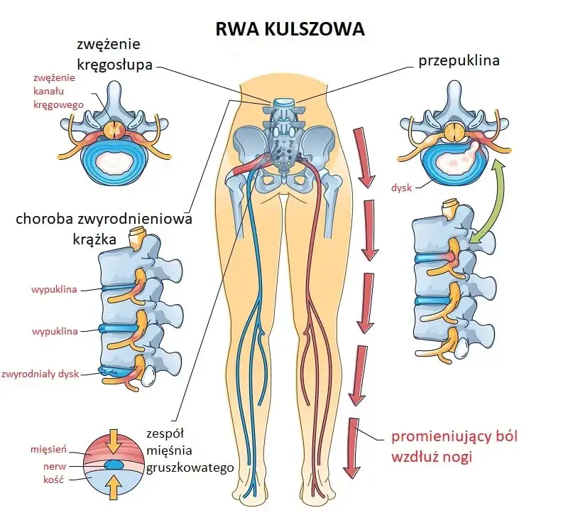 Rodzaje nerwob&oacute;l&oacute;w schemat rwa kulszowa międzyżebrowy tr&oacute;jdzielny
