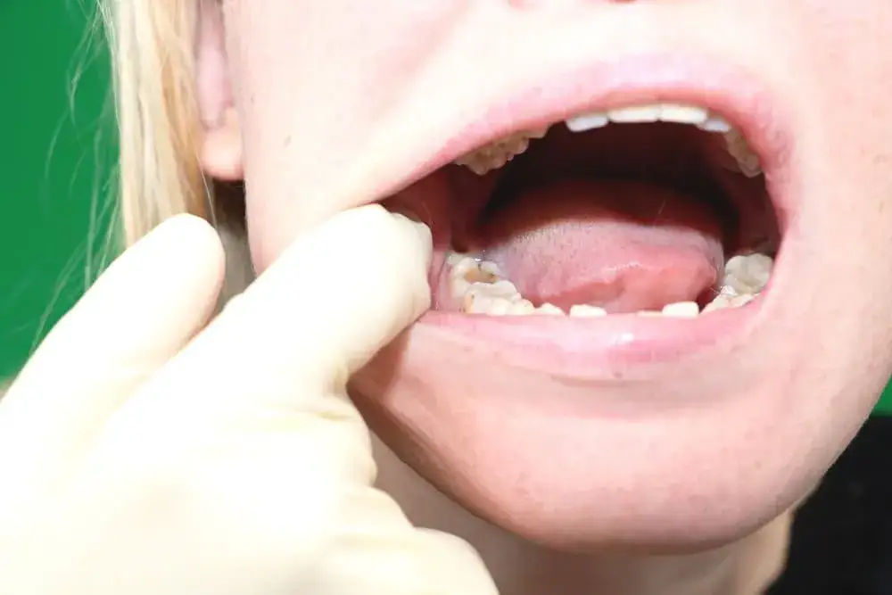kiedy iść do dentysty, objawy pilnej wizyty u stomatologa, opuchlizna twarzy ból zęba